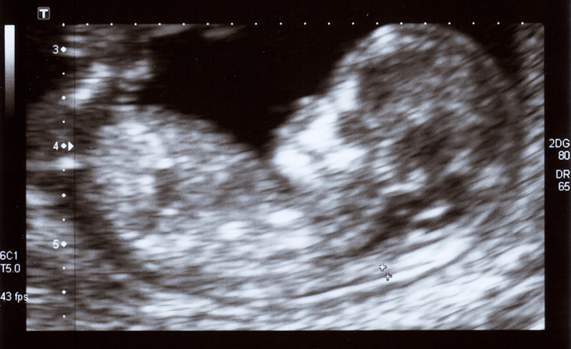 Special Ultrasound Examinations and Prenatal Diagnostics